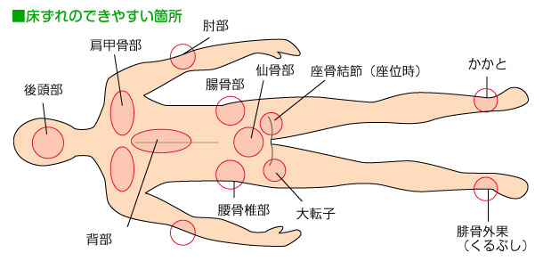 床ずれのできやすい箇所